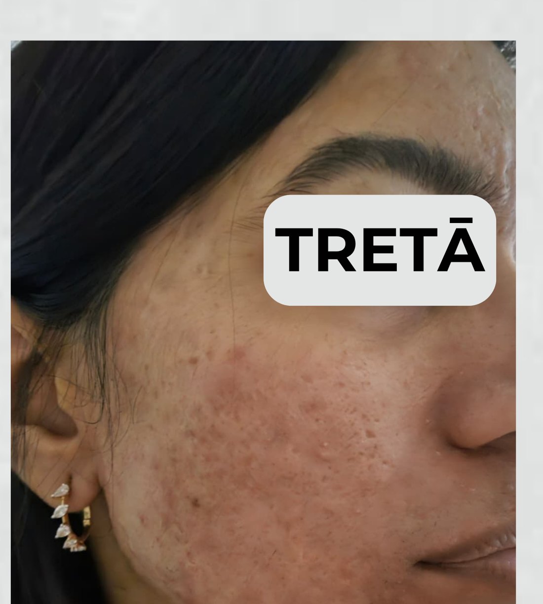 Acne scars after treatment