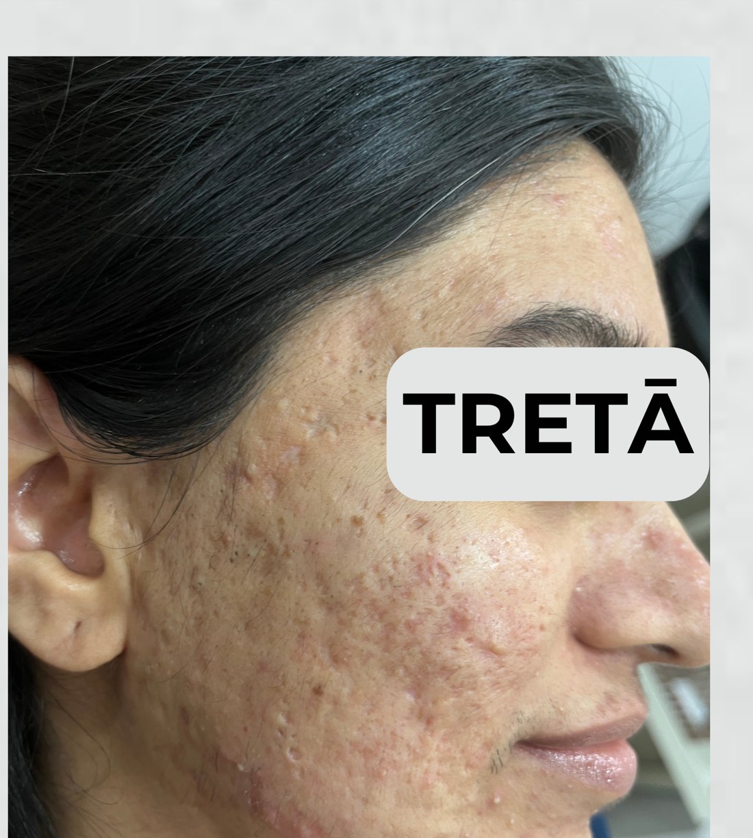 Acne scars before treatment